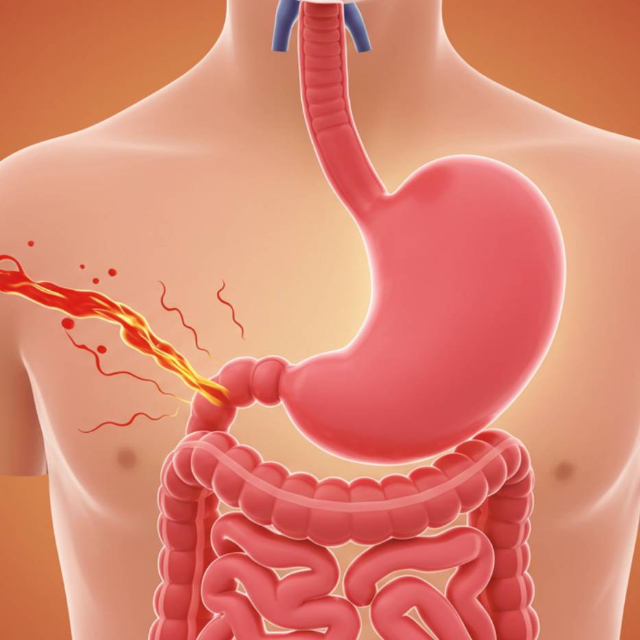 Acid Reflux and GERD