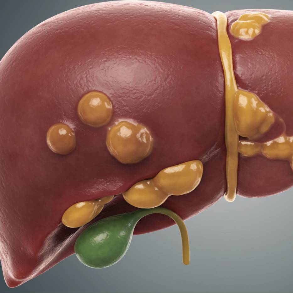Fatty Liver Disease and Liver Conditions